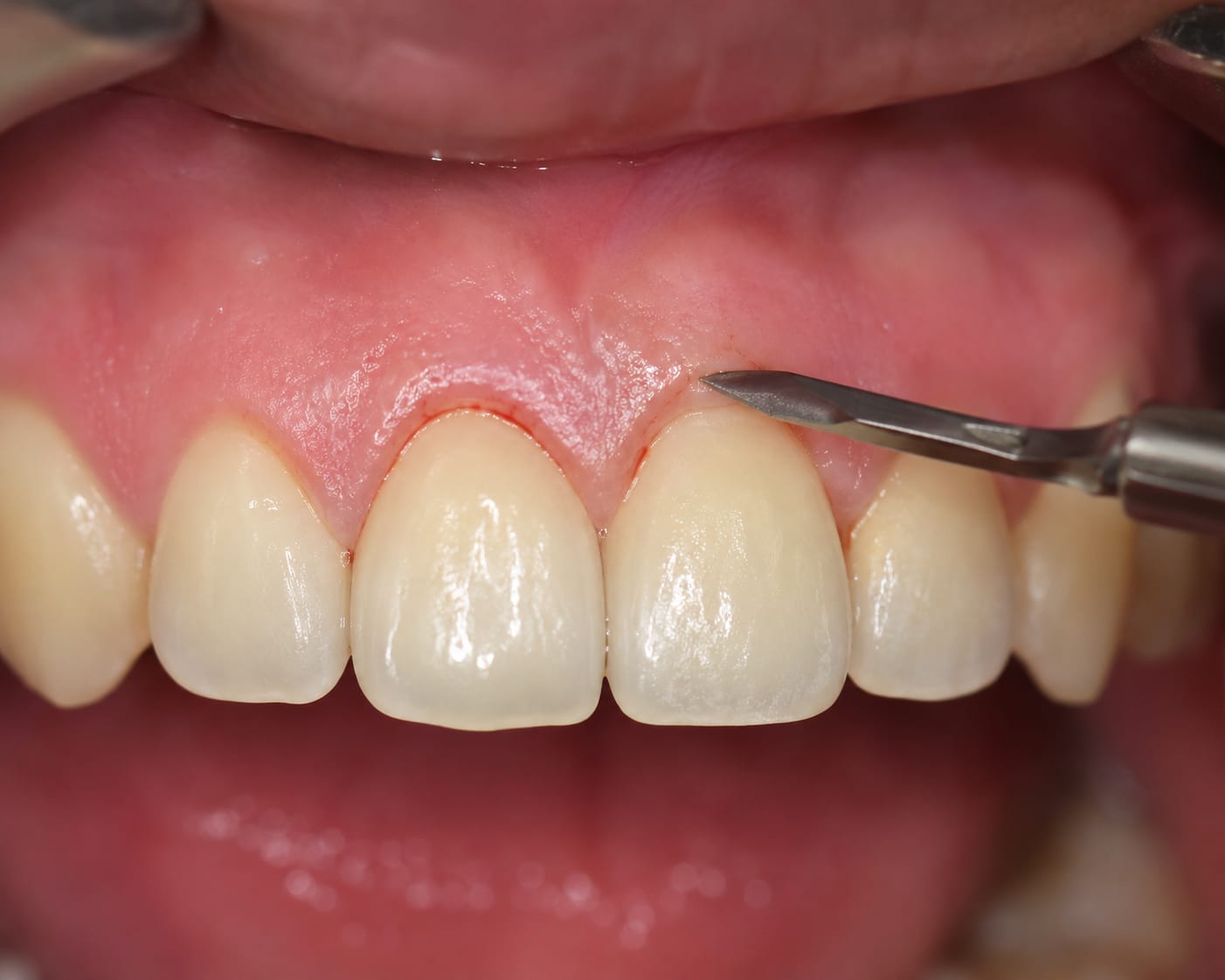 Gingivectomy / Potong Gusi