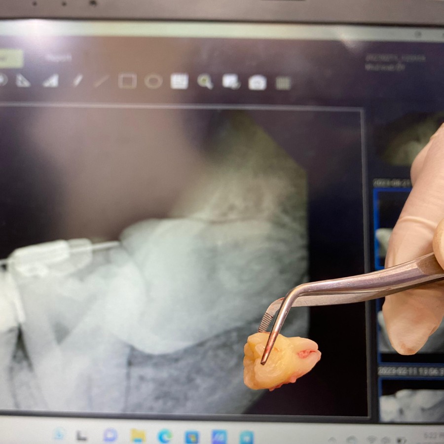 Odentektomy / Cabut Gigi Impaksi